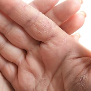 کمبود چه ویتامینی باعث پوسته شدن کف دست می‌شود؟ 