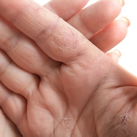 کمبود چه ویتامینی باعث پوسته شدن کف دست می‌شود؟ 