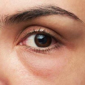 کمبود کدام ویتامین باعث پف زیر چشم می‌شود؟
